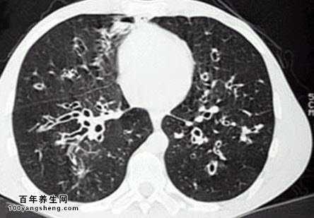 支气管扩张的临床症状有哪些及经络穴位诊断