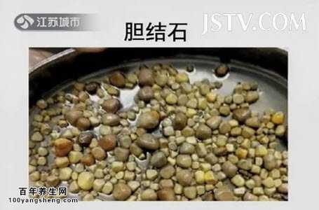 20151011万家灯火视频和笔记:纪小龙,肾结石,胆结石,膀胱结石