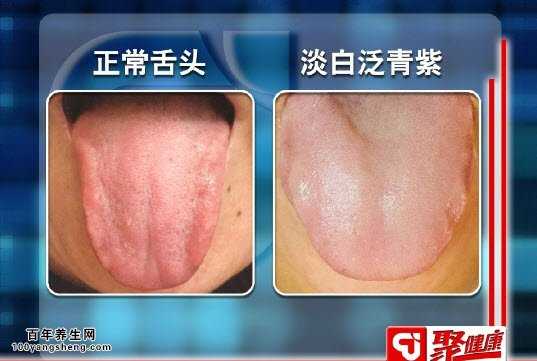 聚健康 阳虚的人舌色淡白,舌体胖大有齿痕,舌苔白滑或水滑.