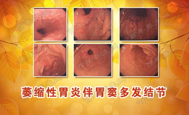 20170105养生堂视频和笔记:朱丽明,萎缩性胃炎,十二指肠溃疡,打嗝